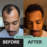 Hair ResQ™ Clinical Regrowth Protocol 2.0 Adenosine + GHK-Cu Targeted Micro-Infusion Delivery