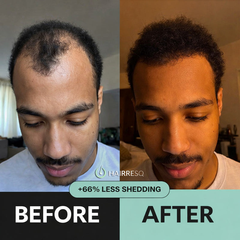 Hair ResQ™ Clinical Regrowth Protocol 2.0 Adenosine + GHK-Cu Targeted Micro-Infusion Delivery