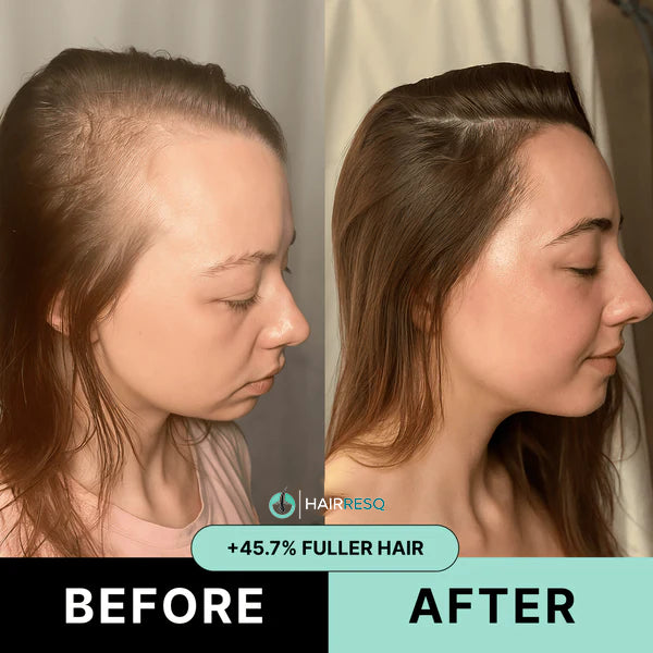 Hair ResQ™ Clinical Regrowth Protocol 2.0 Adenosine + GHK-Cu Targeted Micro-Infusion Delivery For Women