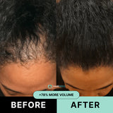Hair ResQ™ Clinical Regrowth Protocol 2.0 Adenosine + GHK-Cu Targeted Micro-Infusion Delivery For Women