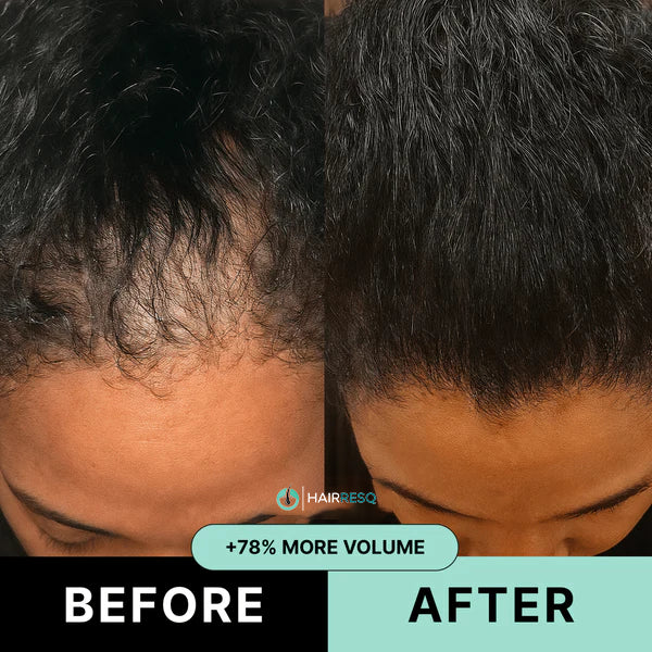 Hair ResQ™ Clinical Regrowth Protocol 2.0 Adenosine + GHK-Cu Targeted Micro-Infusion Delivery For Women