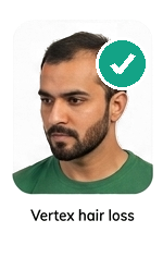 Vertex hair loss