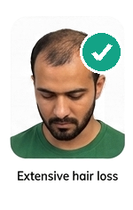 Extensive hair loss