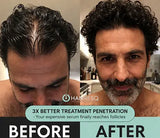 Hair ResQ™ Clinical Regrowth Protocol 2.0 Adenosine + GHK-Cu Targeted Micro-Infusion Delivery