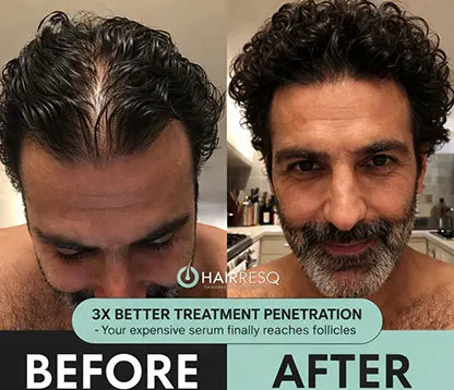 Hair ResQ™ Clinical Regrowth Protocol 2.0 Adenosine + GHK-Cu Targeted Micro-Infusion Delivery