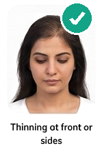 Thinning at front or sides