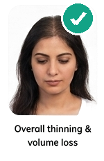 Overall thinning and volume loss