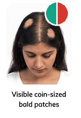 Visible coin-sized bald patches