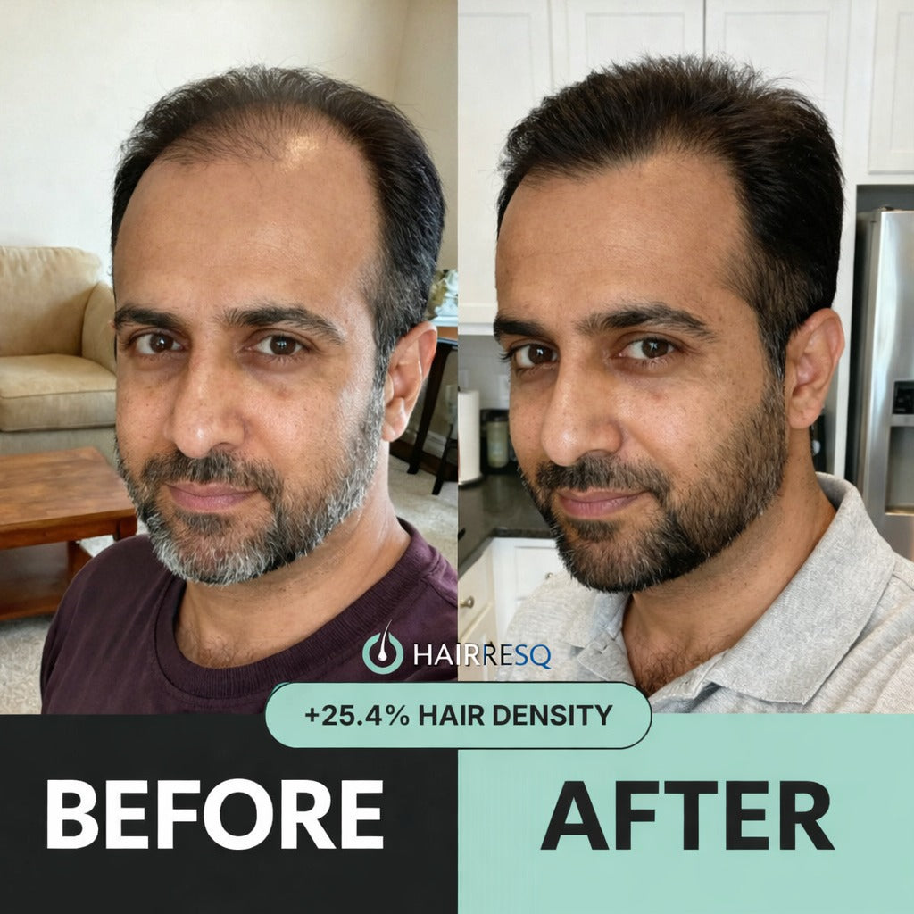 Finasteride vs Hairresq